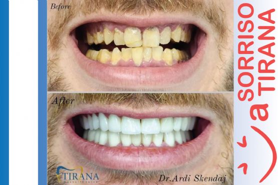 Protetike / protetika fikse / kurora zirkoni / kurora e zirconia / kurora porcelani / kurora emax / kurora porcelani tirane veneers emax / veneers teeth / veshje dhembi / veshje per dhembet / faseta dhembesh / laburator dentar / LUNA DENTAL CLINIC